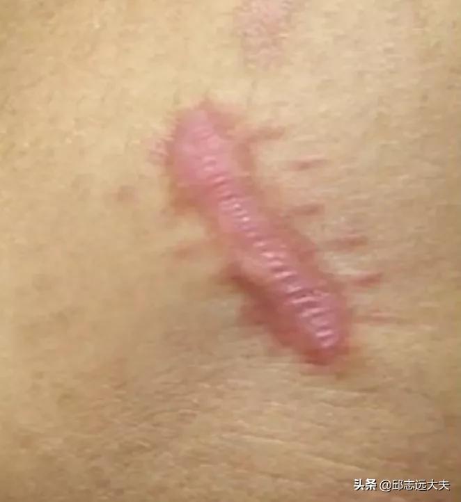 小孩伤口怎么不留疤,伤口怎么不留疤快速恢复