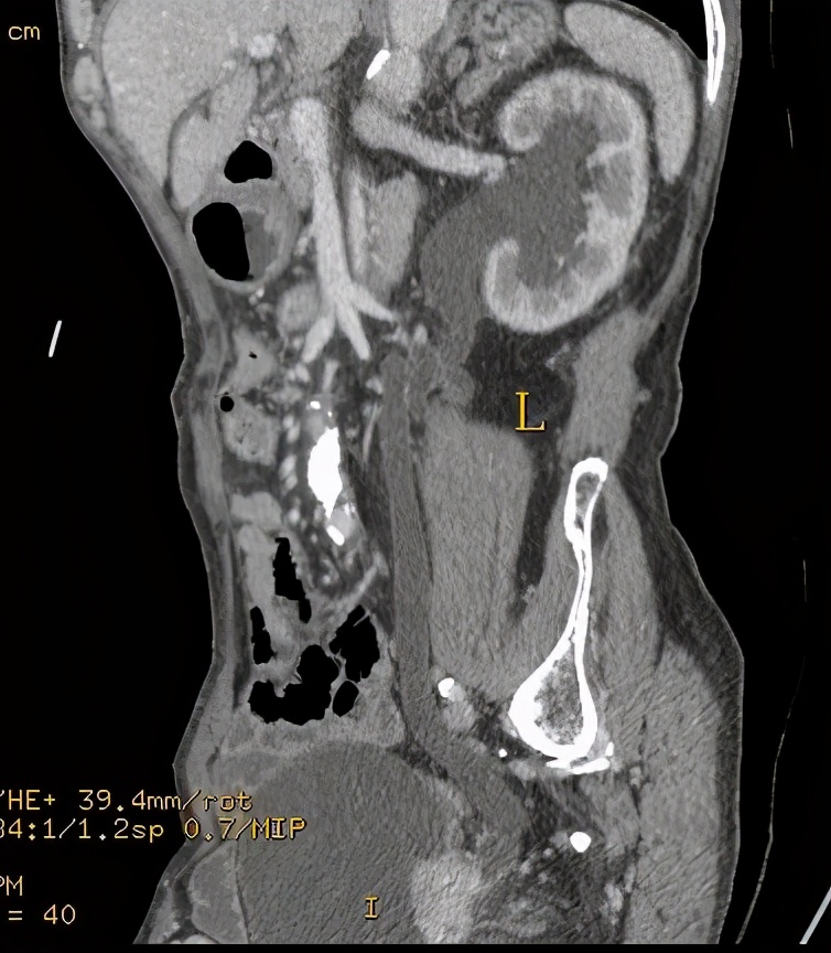 尿路造影输尿管间断显影,静脉尿路造影和排泄性尿路造影