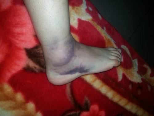 踝关节扭伤恢复训练,踝关节扭伤微创手术多久恢复