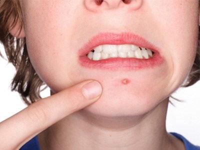 50岁下巴长痘痘是什么原因引起的,下巴突然长痘痘怎么快速消除