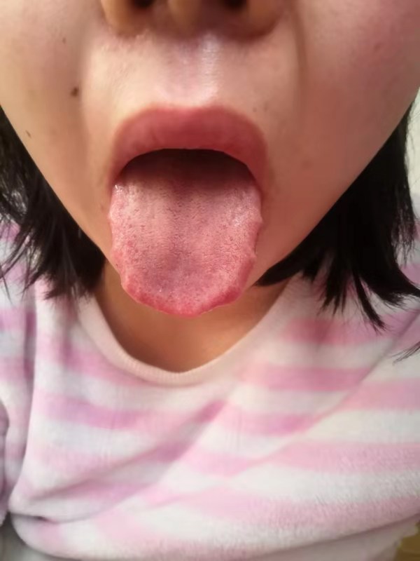 中药治疗腮腺炎、低热患者病案1例（1周）