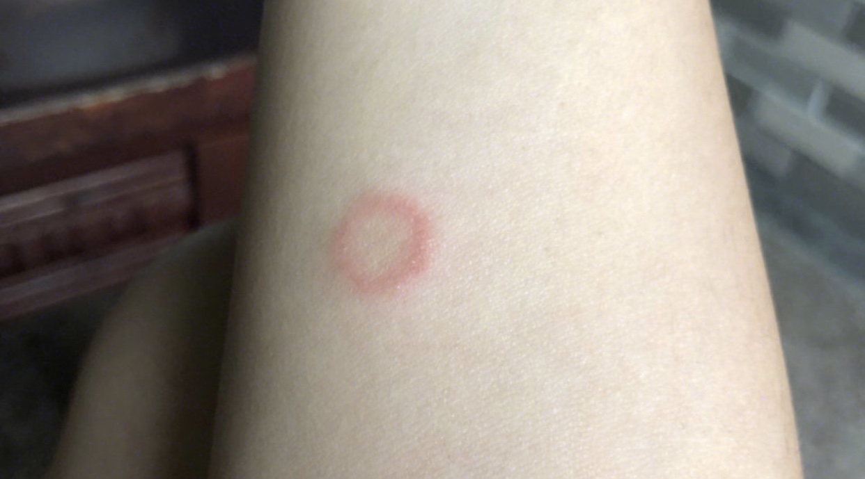 猫癣铲屎官注意什么,猫癣碰了会怎么样