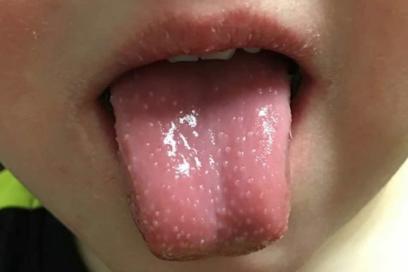 高烧引起的死亡病例,高烧致死的儿童