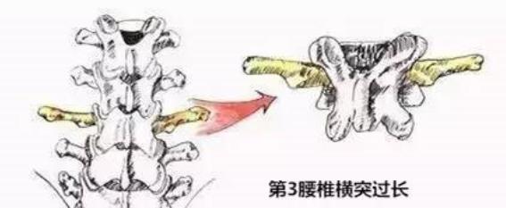 腰肌劳损都是因为什么导致,腰肌劳损是怎么形成的怎么治