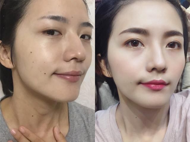 娲昏鍖栫榾鐨勪腑鎴愯嵂鍙互娣″寲鏂戠偣,娲昏鍖栫榾鍏婚鑽湁鍝簺