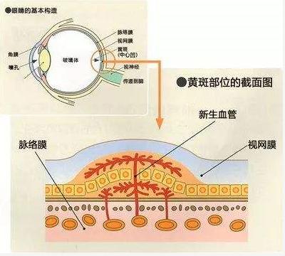 好消息关于医保,眼底病手术费进医保吗