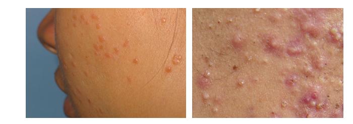 皮肤病蛇缠腰是什么症状,手部常见皮肤病的症状及治疗