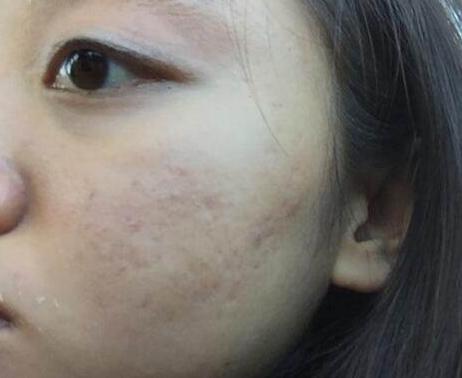 教你4个祛痘印最有效的方法,怎么去痘印最快最有效最简单