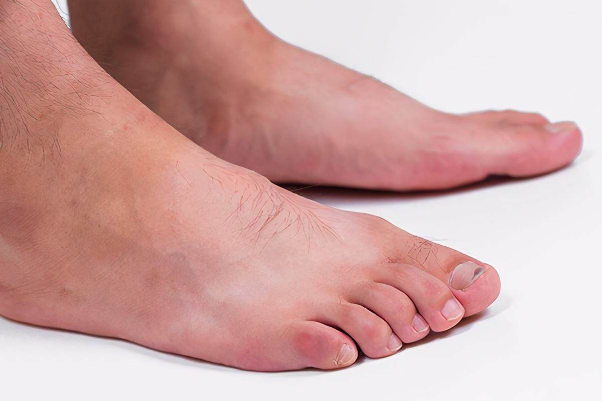 脚趾甲沟炎冒出一坨肉,脚趾甲老是往肉里长怎么矫正