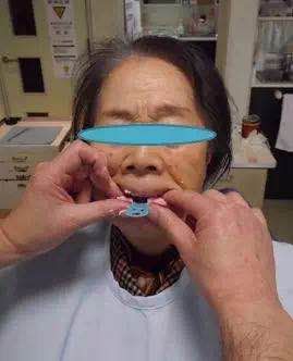 咬合重建详细步骤,如何制作咬合模型