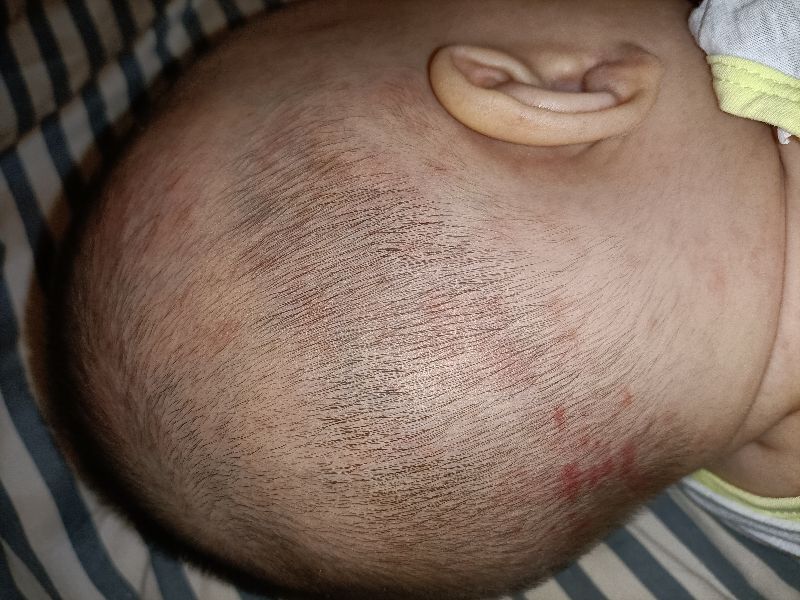 宝宝反复湿疹要崩溃了,湿疹宝宝一定是过敏体质吗