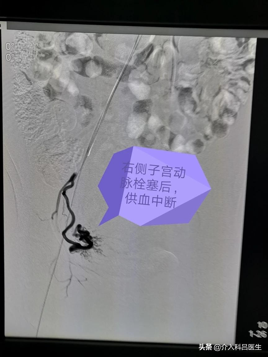 子宫腺肌症中度贫血,女性腺肌症贫血怎么调理