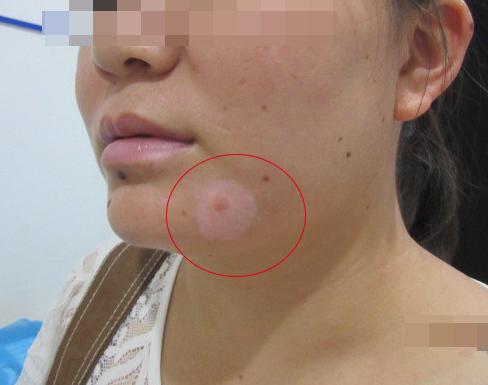 什么是晕痣和白癜风,晕痣型白癜风和白癜风有什么区别