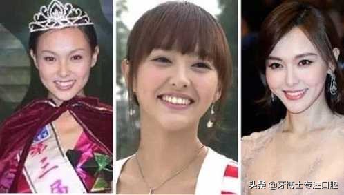 明星牙齿矫正前后对比,明星牙齿矫正都用的什么矫正方式