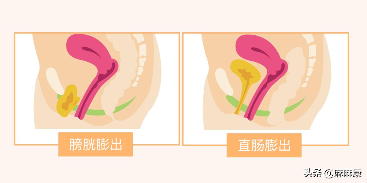 产后下面下垂怎么办,产后如何避免内脏脱垂