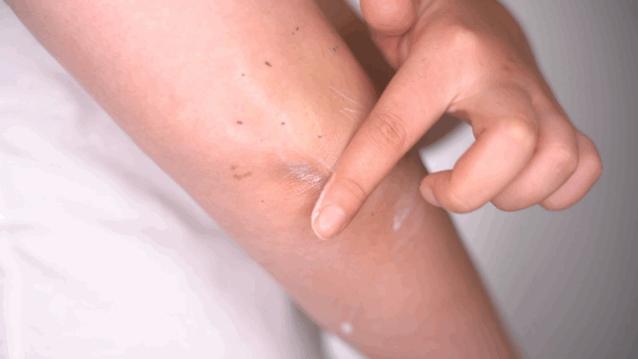 有黑头和没黑头有什么区别,没有长过黑头却长黑头怎么办