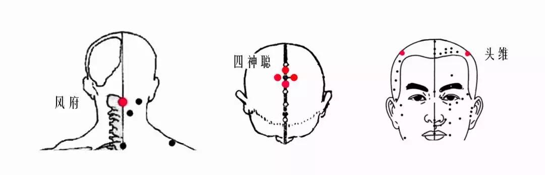 颈椎腰腿痛针刀,针刀颈椎病