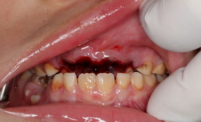 宝宝牙齿磕掉,儿童牙齿磕松了能自己好吗