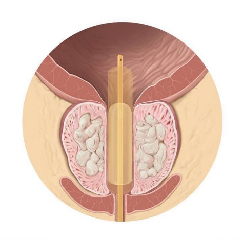 明明有尿但是不想去尿,明明有尿又尿不出来怎么办