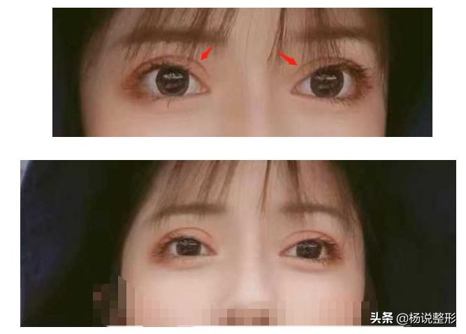 整形医生科普割双眼皮必看攻略,割双眼皮一定好看吗