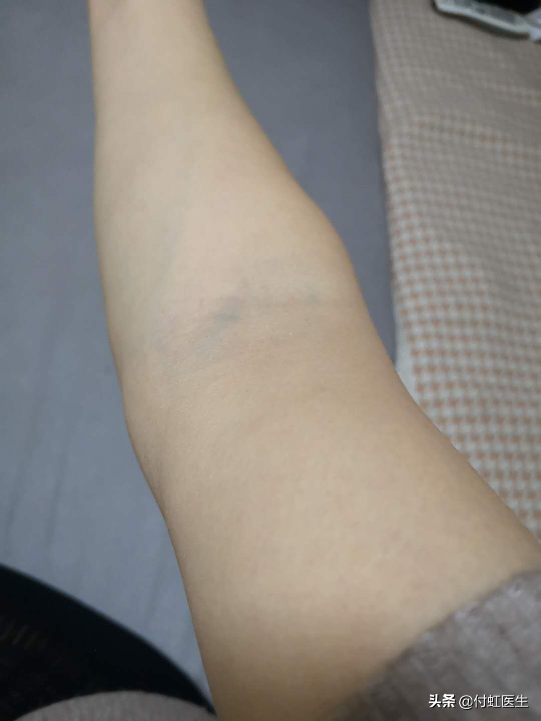 网购衣服试穿后得荨麻疹,衣服荨麻疹