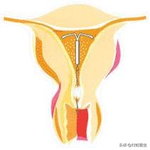 宫内避孕环真的可以避孕吗,又能避孕又能调经的药