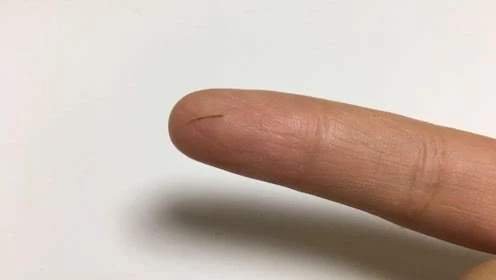 木刺扎到手指急救妙招,不小心把刺戳进手指里怎么办