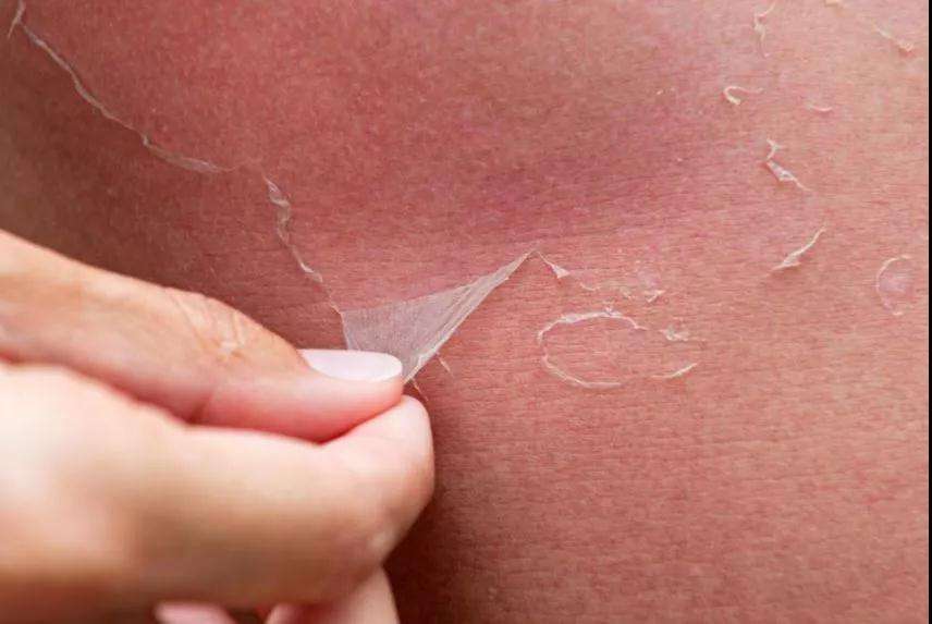 阳光浴严重晒伤怎么办,晒伤怎么预防