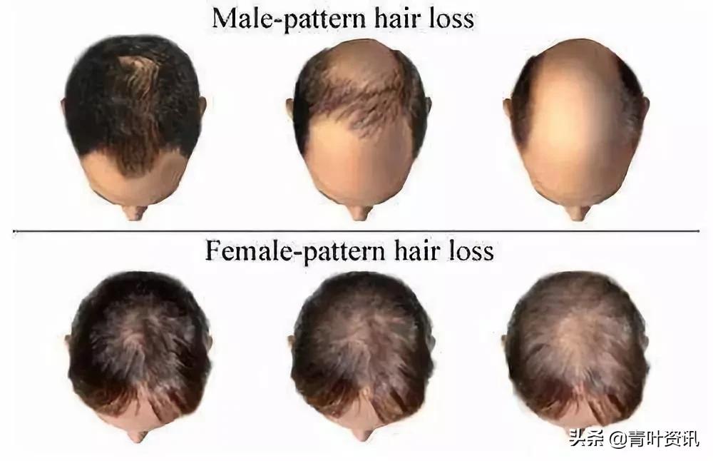 中医辨证遗传性脱发,遗传性脱发怎么治疗