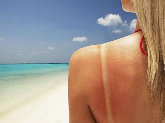 夏天湿疹与夏季皮炎的区别,顽固湿疹日光性皮炎怎么治