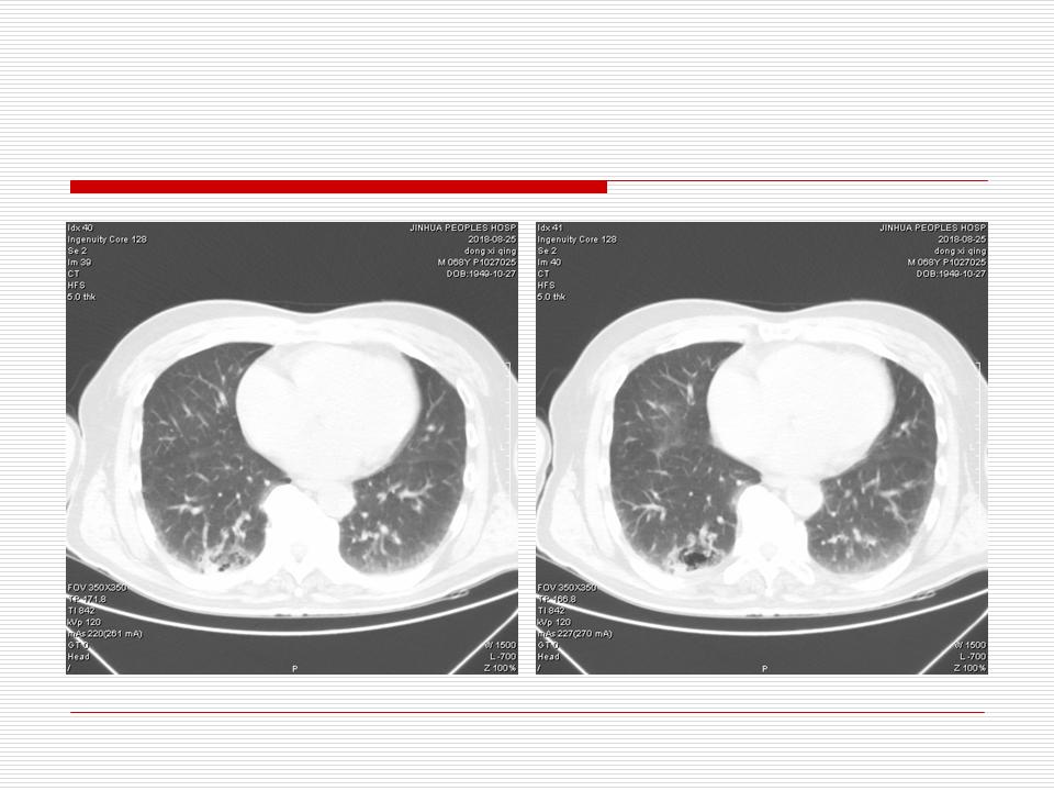 像炎症的肺癌能治好吗,医生说可能是肺癌也可能是炎症