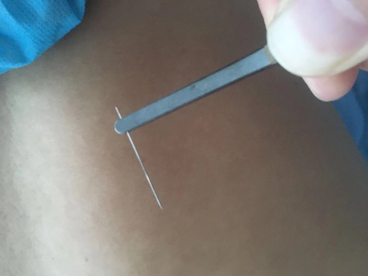 医院针灸没扎完能退吗,医院里针灸为何不管拔针