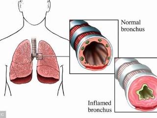 预防肺气肿的疫苗,肺气肿应该怎样预防