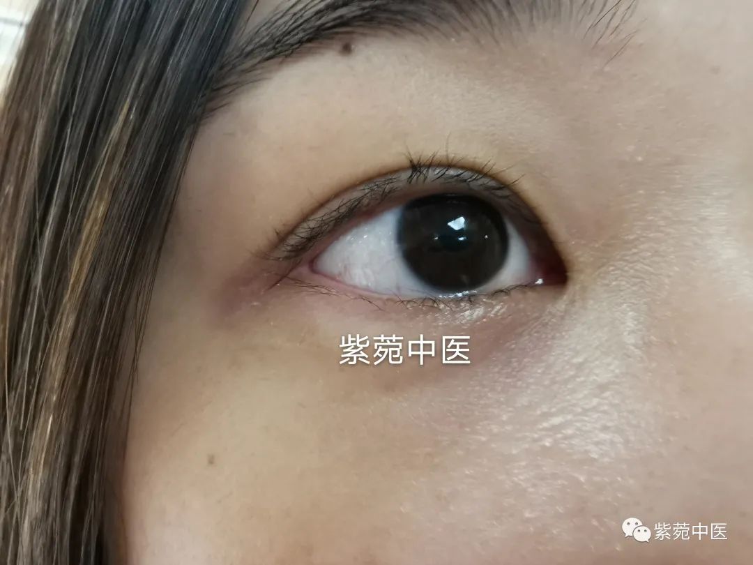 长期戴隐形眼镜、看电脑，眼睛又红又痒？医生：上甘草泻心