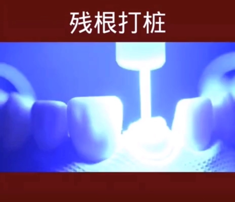 良心牙医不建议拔残根,牙医没拔干净有残根会怎样