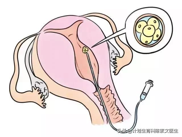 宫外孕微创手术后多久可以怀孕,有没有宫外孕后自然怀孕成功的