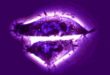 女性妇科癌症有哪些表现,妇科癌症早期10个症状