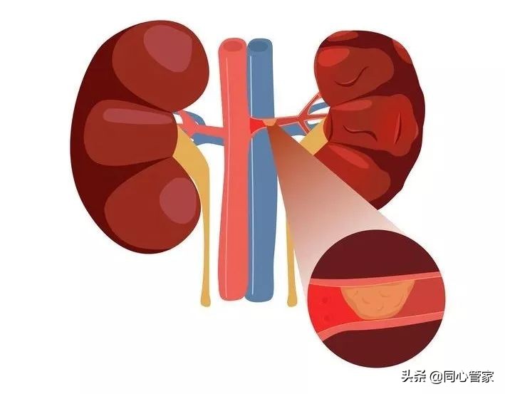 血管狭窄如何扼住生命的咽喉？让你全身器官都遭殃？
