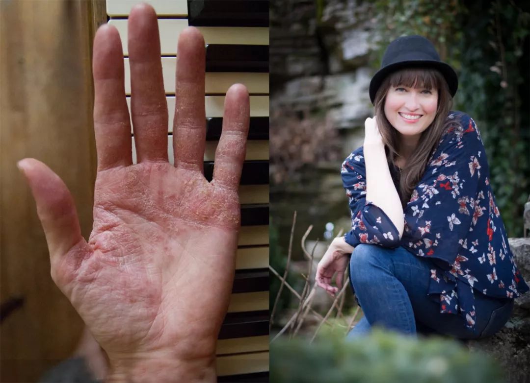 念珠菌的预防方法,念珠菌怎样预防