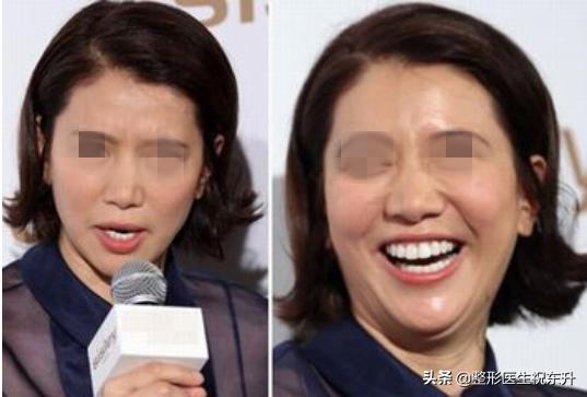 双下巴、脖子粗,又丑又显老,如何减掉双下巴?