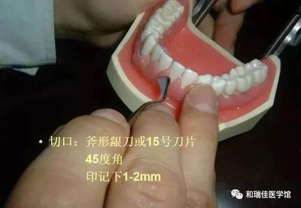 松牙固定需要什么条件,钢丝松牙固定操作流程