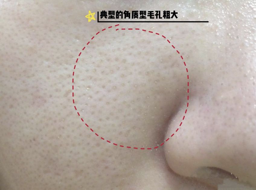 油皮毛孔大泛红怎么改善,干皮毛孔粗大怎么改善小妙招