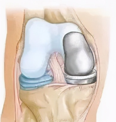 膝骨关节炎只能“换关节”?看看关节外科大夫如何“保膝”
