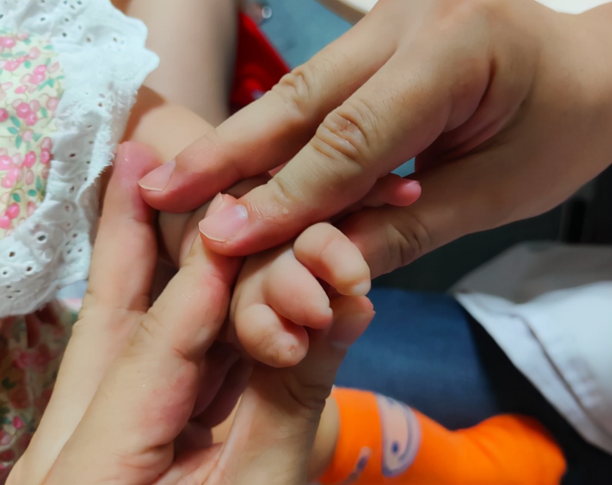 并指畸形免植皮案例,并指畸形