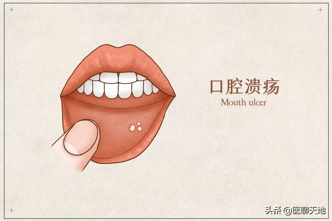 嘴巴里疼好像起泡了,嘴巴里溃烂疼的厉害怎么治