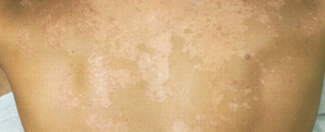 为什么汗斑好了又复发了,为什么汗斑会经常复发