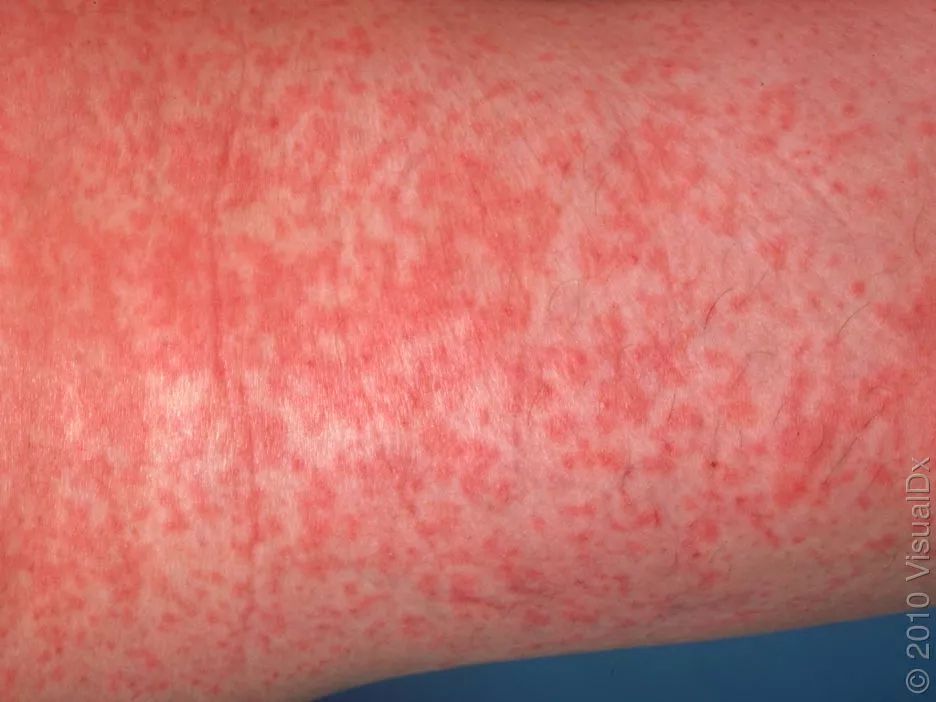 发热出红疹子可以吃过敏药吗,发热皮疹会反复么