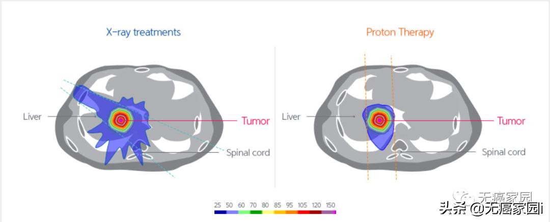 质子治疗手术适合大型肿瘤,肿瘤不能根治吗
