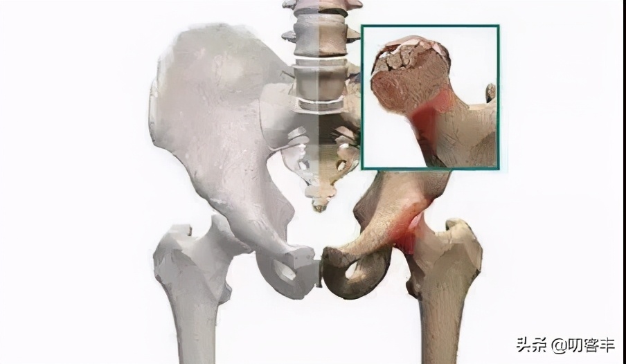 儿童股骨头缺血性坏死影响发育吗,孩子股骨头坏死症状