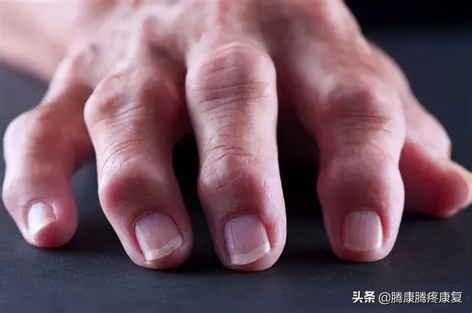 类风湿关节炎病因与发病机制,类风湿关节炎的病因与发病机制